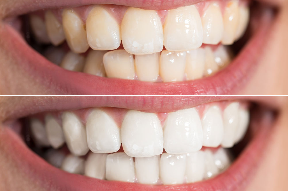 7 Effective Teeth Whitening Products