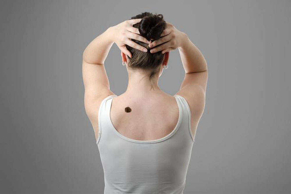 5 Rare Types Of Skin Cancer