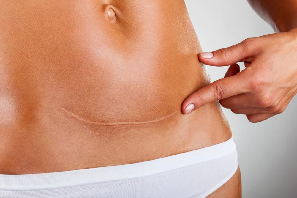 Early Signs and Treatment Options for Ovarian Cancer