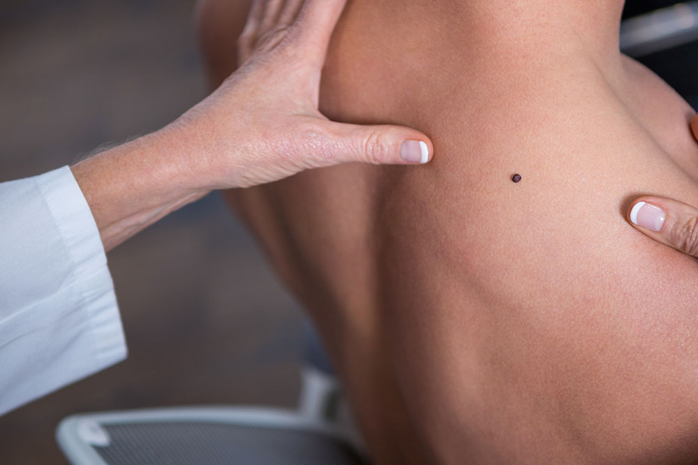 Symptoms and Types of Melanoma